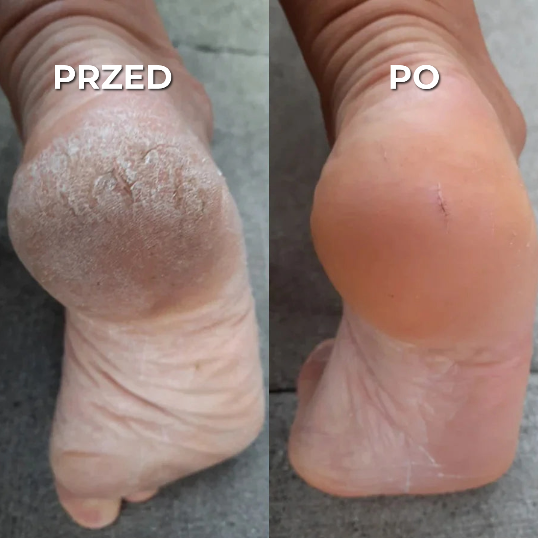 Novaloza™ | Profesjonalny Usuwacz Modzeli