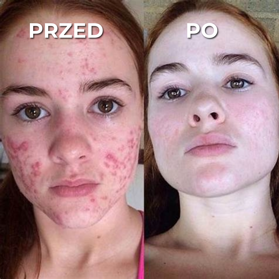 Profesjonalny krem do pielęgnacji blizn